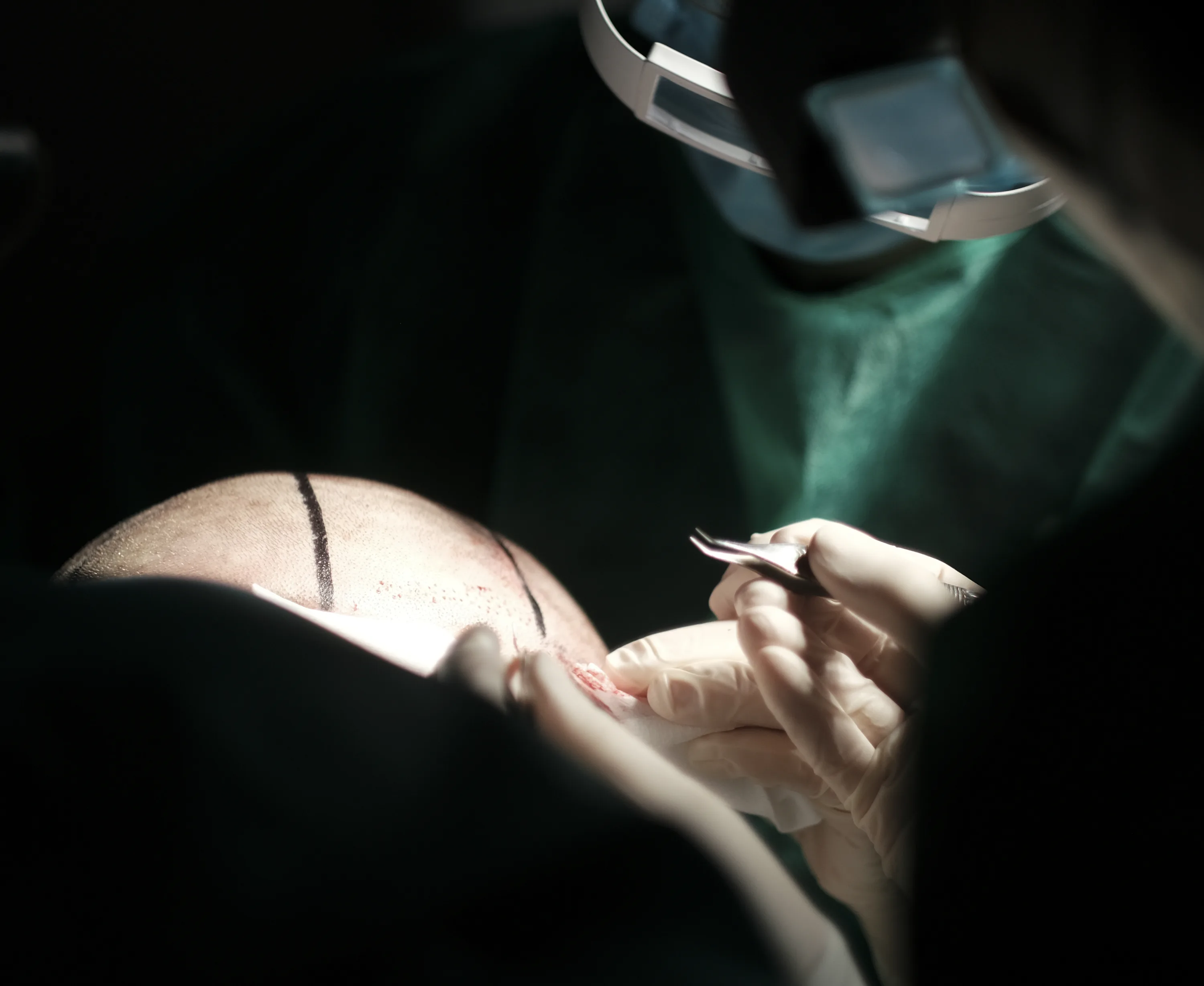 Przeszczep włosów FUE w klinice SkyClinic